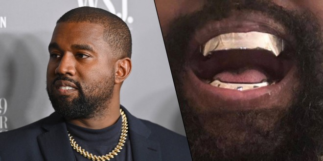 Kanye West s\'est fait greffer des dents en titane d\'une valeur de 850 000 dollars